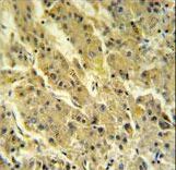 PSG7 Antibody IHC of formalin-fixed and paraffin-embedded hepatocarcinoma followed by peroxidase-conjugated secondary antibody and DAB staining.