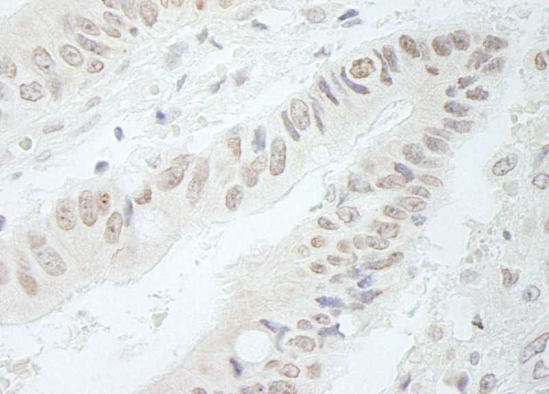 Detection of Human RFC3 by Immunohistochemistry. Sample: FFPE section of human colon carcinoma. Antibody: Affinity purified rabbit anti-RFC3 used at a dilution of 1:250.