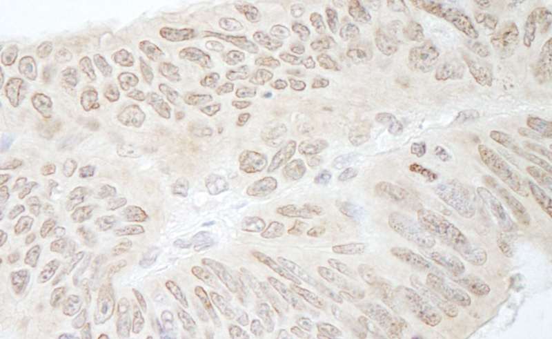 Detection of Human RFC3 by Immunohistochemistry. Sample: FFPE section of human colon carcinoma. Antibody: Affinity purified rabbit anti-RFC3 used at a dilution of 1:1000 (1 ug/ml). Detection: DAB.