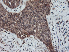 IHC of paraffin-embedded Adenocarcinoma of Human ovary tissue using anti-RFPL3 mouse monoclonal antibody.