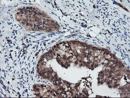 IHC of paraffin-embedded Adenocarcinoma of Human endometrium tissue using anti-RFPL3 mouse monoclonal antibody.