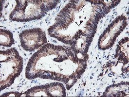 IHC of paraffin-embedded Adenocarcinoma of Human colon tissue using anti-RFPL3 mouse monoclonal antibody.
