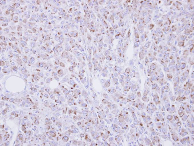 IHC of paraffin-embedded U87 xenograft using RGMB antibody at 1:100 dilution.