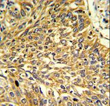 Formalin-fixed and paraffin-embedded human lung carcinoma reacted with RGP1 Antibody , which was peroxidase-conjugated to the secondary antibody, followed by DAB staining. This data demonstrates the use of this antibody for immunohistochemistry; clinical relevance has not been evaluated.