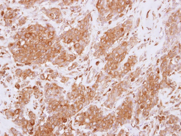 IHC of paraffin-embedded Breast ca using RGS10 antibody at 1:250 dilution.