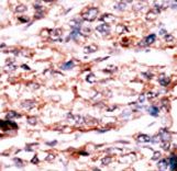 Formalin-fixed and paraffin-embedded human cancer tissue reacted with the primary antibody, which was peroxidase-conjugated to the secondary antibody, followed by AEC staining. This data demonstrates the use of this antibody for immunohistochemistry; clinical relevance has not been evaluated. BC = breast carcinoma; HC = hepatocarcinoma.