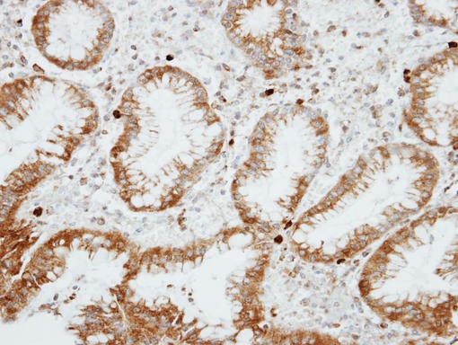 IHC of paraffin-embedded GASTRIC CA using RGS14 antibody at 1:100 dilution.