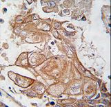 Formalin-fixed and paraffin-embedded human lung carcinoma tissue reacted with Phospho-RGS19-pS151.control antibody, which was peroxidase-conjugated to the secondary antibody, followed by DAB staining. This data demonstrates the use of this antibody for immunohistochemistry; clinical relevance has not been evaluated.