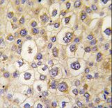Formalin-fixed and paraffin-embedded human hepatocarcinoma tissue reacted with ARHE antibody , which was peroxidase-conjugated to the secondary antibody, followed by DAB staining. This data demonstrates the use of this antibody for immunohistochemistry; clinical relevance has not been evaluated.