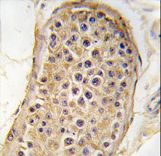Formalin-fixed and paraffin-embedded human testis tissue reacted with RICTOR antibody , which was peroxidase-conjugated to the secondary antibody, followed by DAB staining. This data demonstrates the use of this antibody for immunohistochemistry; clinical relevance has not been evaluated.