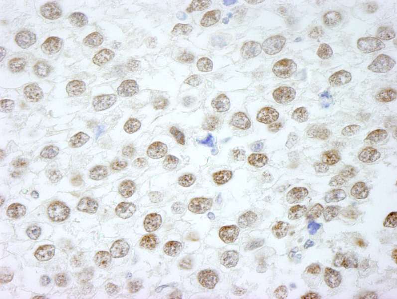 Detection of Human RIF1 by Immunohistochemistry. Sample: FFPE section of human seminoma. Antibody: Affinity purified rabbit anti-RIF1 used at a dilution of 1:250.