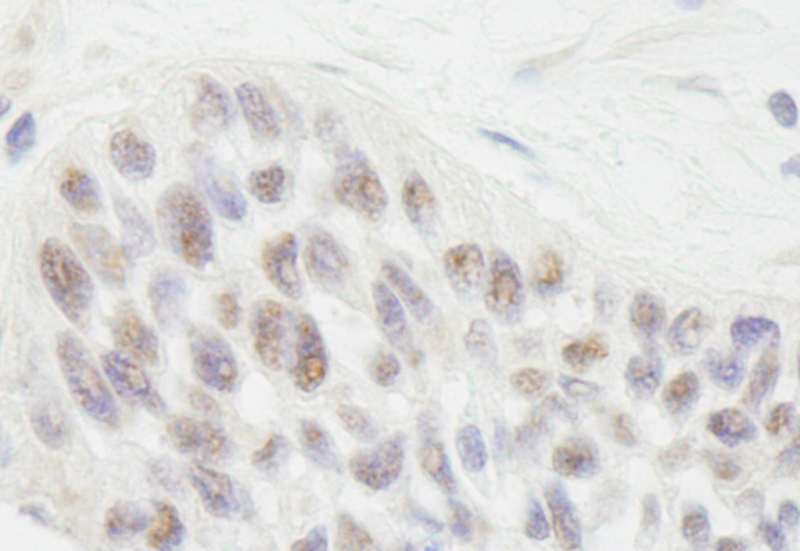 Detection of Human RIF1 by Immunohistochemistry. Sample: FFPE section of human laryngeal squamous cell carcinoma. Antibody: Affinity purified rabbit anti- RIF1 used at a dilution of 1:1000 (1 Detection: DAB.