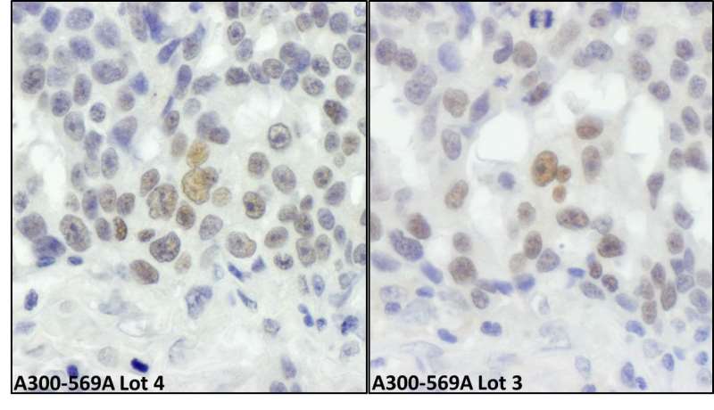 Detection of Human RIF1 by Immunohistochemistry. Sample: FFPE section of human ovarian carcinoma. Antibody: Affinity purified rabbit anti-RIF1 ( Lot4 - left and Lot 3 - right) used at a dilution of 1:1000 (1 ug/ml). Detection: DAB.