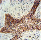 RILPL2 antibody immunohistochemistry of formalin-fixed and paraffin-embedded human lung carcinoma followed by peroxidase-conjugated secondary antibody and DAB staining.