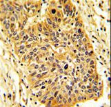 Formalin-fixed and paraffin-embedded human lung carcinoma reacted with RIOK1 Antibody , which was peroxidase-conjugated to the secondary antibody, followed by DAB staining. This data demonstrates the use of this antibody for immunohistochemistry; clinical relevance has not been evaluated.