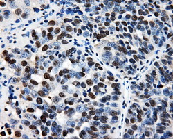 IHC of paraffin-embedded Adenocarcinoma of ovary tissue using anti-RALBP1 mouse monoclonal antibody. (Dilution 1:50).