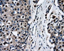 IHC of paraffin-embedded Adenocarcinoma of breast tissue using anti-RALBP1 mouse monoclonal antibody. (Dilution 1:50).