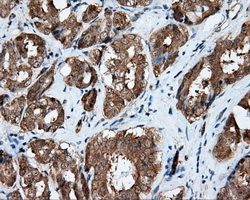 IHC of paraffin-embedded Carcinoma of prostate tissue using anti-RALBP1 mouse monoclonal antibody. (Dilution 1:50).