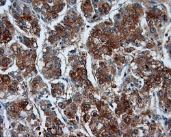 IHC of paraffin-embedded Carcinoma of liver tissue using anti-RALBP1 mouse monoclonal antibody. (Dilution 1:50).