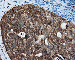 IHC of paraffin-embedded Adenocarcinoma of ovary tissue using anti-RALBP1 mouse monoclonal antibody. (Dilution 1:50).