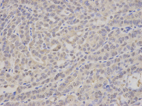 Immunohistochemistry of paraffin-embedded human thyroid cancer using PSMA4 antibody at dilution of 1:100 (400x lens).