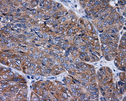 IHC of paraffin-embedded Adenocarcinoma of endometrium tissue using anti-RALBP1 mouse monoclonal antibody. (Dilution 1:50).