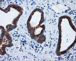 IHC of paraffin-embedded Carcinoma of prostate tissue using anti-RALBP1 mouse monoclonal antibody. (Dilution 1:50).