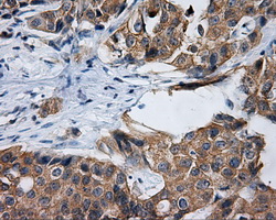 IHC of paraffin-embedded Adenocarcinoma of breast tissue using anti-RALBP1 mouse monoclonal antibody. (Dilution 1:50).