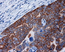 IHC of paraffin-embedded Adenocarcinoma of ovary tissue using anti-RALBP1 mouse monoclonal antibody. (Dilution 1:50).