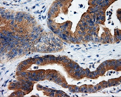 IHC of paraffin-embedded Adenocarcinoma of colon tissue using anti-RALBP1 mouse monoclonal antibody. (Dilution 1:50).
