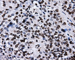 IHC of paraffin-embedded Carcinoma of bladder tissue using anti-RALBP1 mouse monoclonal antibody. (Dilution 1:50).