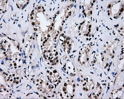 IHC of paraffin-embedded Carcinoma of prostate tissue using anti-RALBP1 mouse monoclonal antibody. (Dilution 1:50).