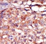 Formalin-fixed and paraffin-embedded human cancer tissue reacted with the primary antibody, which was peroxidase-conjugated to the secondary antibody, followed by AEC staining. This data demonstrates the use of this antibody for immunohistochemistry; clinical relevance has not been evaluated. BC = breast carcinoma; HC = hepatocarcinoma.