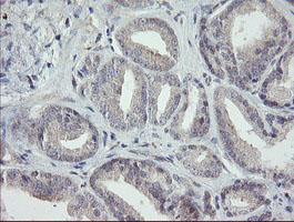 IHC of paraffin-embedded Carcinoma of Human prostate tissue using anti-RIPK1 mouse monoclonal antibody.