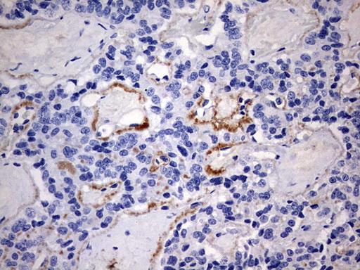 IHC of paraffin-embedded Carcinoma of Human pancreas tissue using anti-RIPK3 mouse monoclonal antibody. (Heat-induced epitope retrieval by 1 mM EDTA in 10mM Tris, pH9.0, 120°C for 3min).