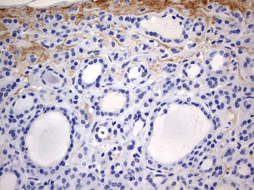IHC of paraffin-embedded Carcinoma of Human thyroid tissue using anti-RIPK3 mouse monoclonal antibody. (Heat-induced epitope retrieval by 1 mM EDTA in 10mM Tris, pH9.0, 120°C for 3min).