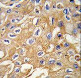 Formalin-fixed and paraffin-embedded human lung carcinoma tissue reacted with RIP3 (RIPK3) antibody , which was peroxidase-conjugated to the secondary antibody, followed by DAB staining. This data demonstrates the use of this antibody for immunohistochemistry; clinical relevance has not been evaluated.