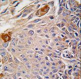 Formalin-fixed and paraffin-embedded human lung carcinoma reacted with RMND5B antibody , which was peroxidase-conjugated to the secondary antibody, followed by DAB staining. This data demonstrates the use of this antibody for immunohistochemistry; clinical relevance has not been evaluated.