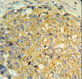 RNASEK Antibody IHC of formalin-fixed and paraffin-embedded human prostate carcinoma followed by peroxidase-conjugated secondary antibody and DAB staining.