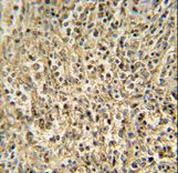 RNT2 antibody immunohistochemistry of formalin-fixed and paraffin-embedded human spleen carcinoma followed by peroxidase-conjugated secondary antibody and DAB staining.