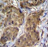 RNF11 Antibody immunohistochemistry of formalin-fixed and paraffin-embedded human breast carcinoma followed by peroxidase-conjugated secondary antibody and DAB staining.