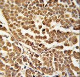 ZNF313 Antibody immunohistochemistry of formalin-fixed and paraffin-embedded human skin carcinoma followed by peroxidase-conjugated secondary antibody and DAB staining.