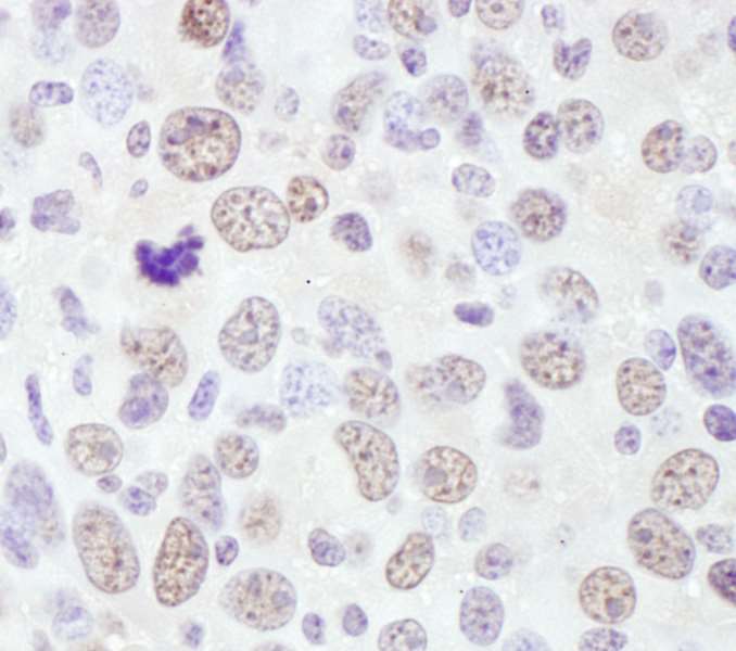 Detection of Mouse RNF138 by Immunohistochemistry. Sample: FFPE section of mouse renal cell carcinoma. Antibody: Affinity purified rabbit anti-RNF138 used at a dilution of 1:1000 (1 ug/ml). Detection: DAB.