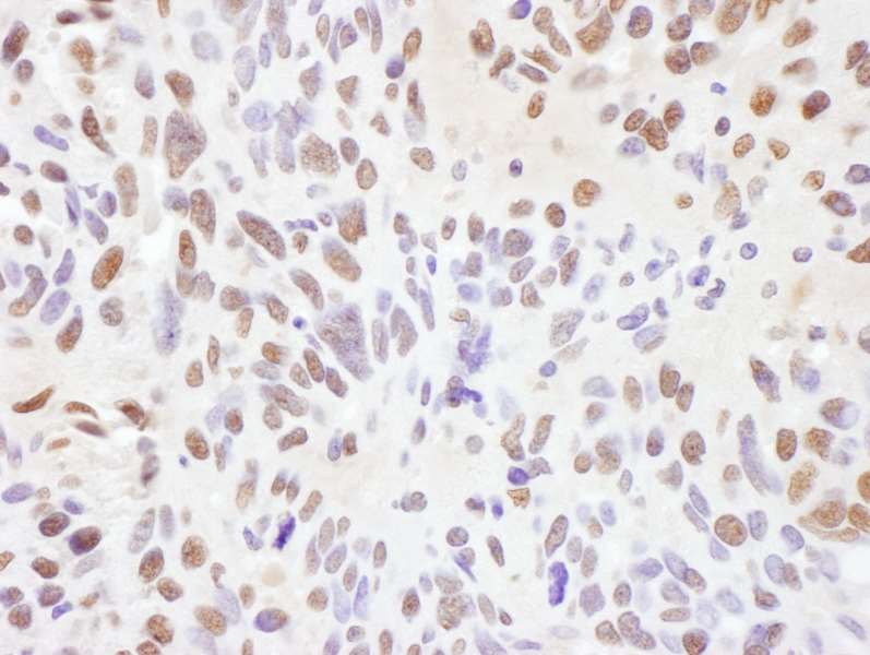 Detection of Human RNF138 by Immunohistochemistry. Sample: FFPE section of human ovarian carcinoma. Antibody: Affinity purified rabbit anti-RNF138 used at a dilution of 1:1000 (1 ug/ml). Detection: DAB.