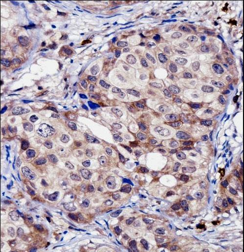 RNF144A Antibody immunohistochemistry of formalin-fixed and paraffin-embedded human breast carcinoma followed by peroxidase-conjugated secondary antibody and DAB staining.