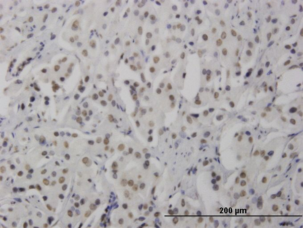 Immunoperoxidase of monoclonal antibody to RNF168 on formalin-fixed paraffin-embedded human prostate cancer. [antibody concentration 1.5 ug/ml]