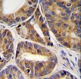 RNF215 Antibody immunohistochemistry of formalin-fixed and paraffin-embedded human prostate carcinoma tissue followed by peroxidase-conjugated secondary antibody and DAB staining.