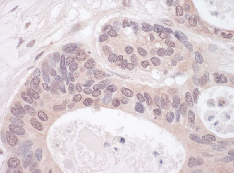 Detection of Human RNGTT by Immunohistochemistry. Sample: FFPE section of human ovarian carcinoma. Antibody: Affinity purified rabbit anti-RNGTT used at a dilution of 1:200 (1 ug/ml). Detection: Vector Laboratories ImmPACT NovaRED Peroxidase Substrate.