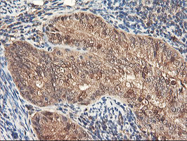 IHC of paraffin-embedded Adenocarcinoma of Human endometrium tissue using anti-RNPEP mouse monoclonal antibody. (Heat-induced epitope retrieval by 10mM citric buffer, pH6.0, 100C for 10min).