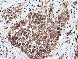 IHC of paraffin-embedded Carcinoma of Human bladder tissue using anti-RNPEP mouse monoclonal antibody. (Heat-induced epitope retrieval by 10mM citric buffer, pH6.0, 100C for 10min).